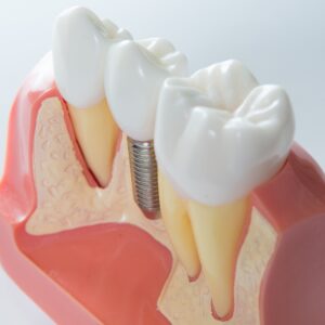 Model of a dental implant